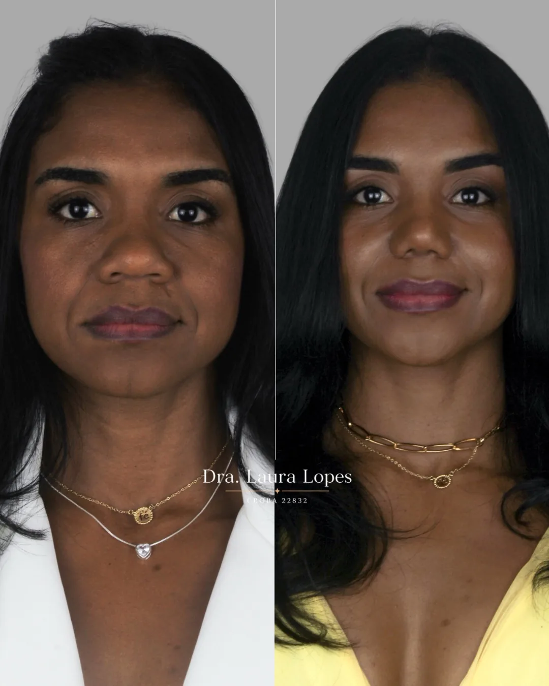Paciente 2 — comparação antes e depois de rinomodelação avançada vista frontal