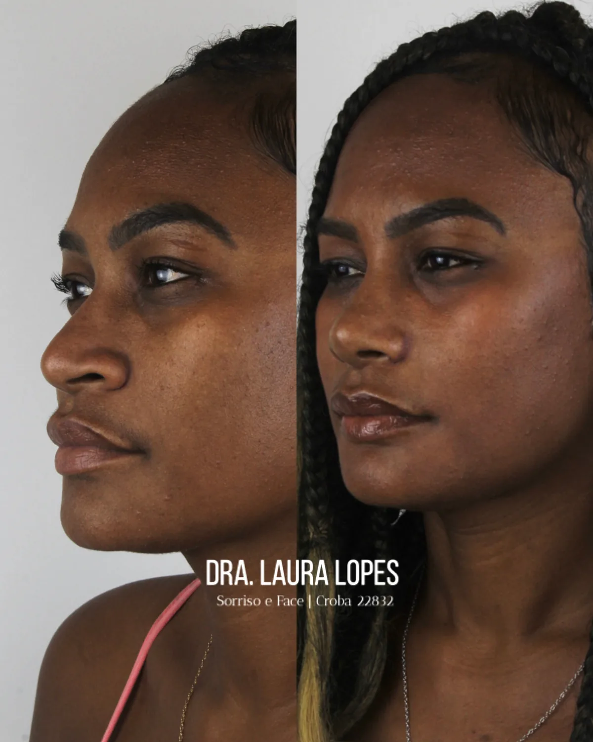 Paciente 1 — comparação antes e depois de rinomodelação avançada vista de perfil