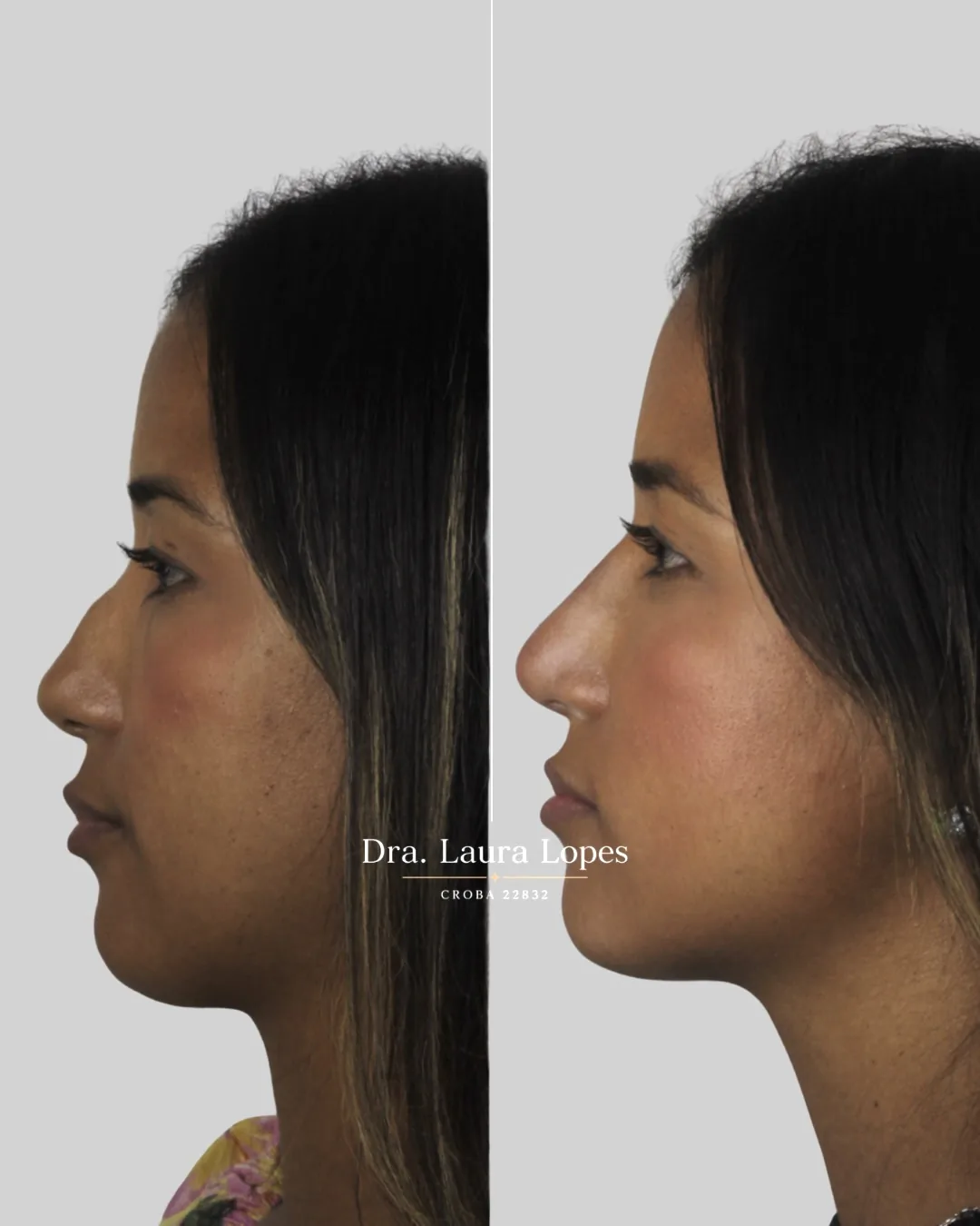 Paciente 3 — comparação antes e depois de rinomodelação avançada vista de perfil