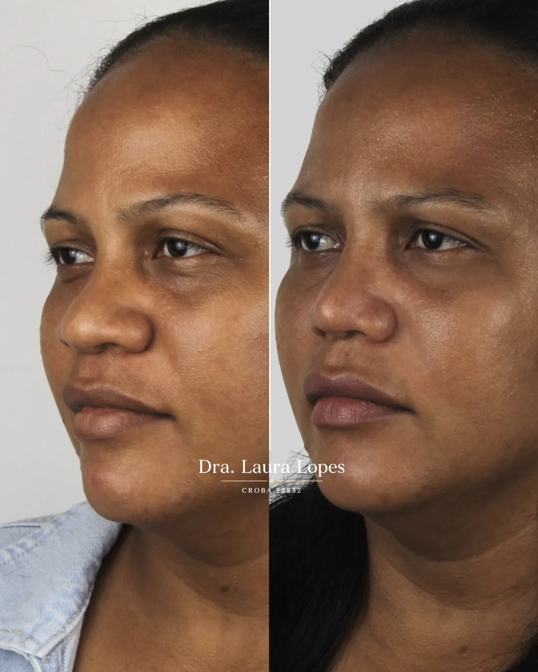 Paciente 5 — comparação antes e depois de rinomodelação avançada vista de perfil
