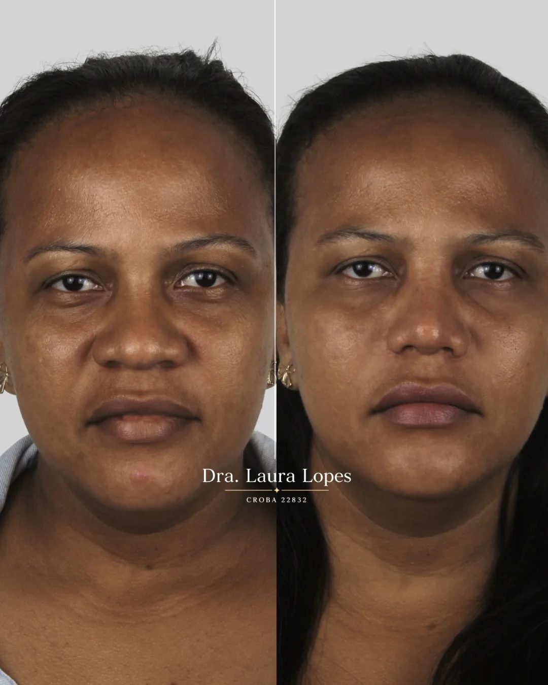 Paciente 5 — comparação antes e depois de rinomodelação avançada vista frontal