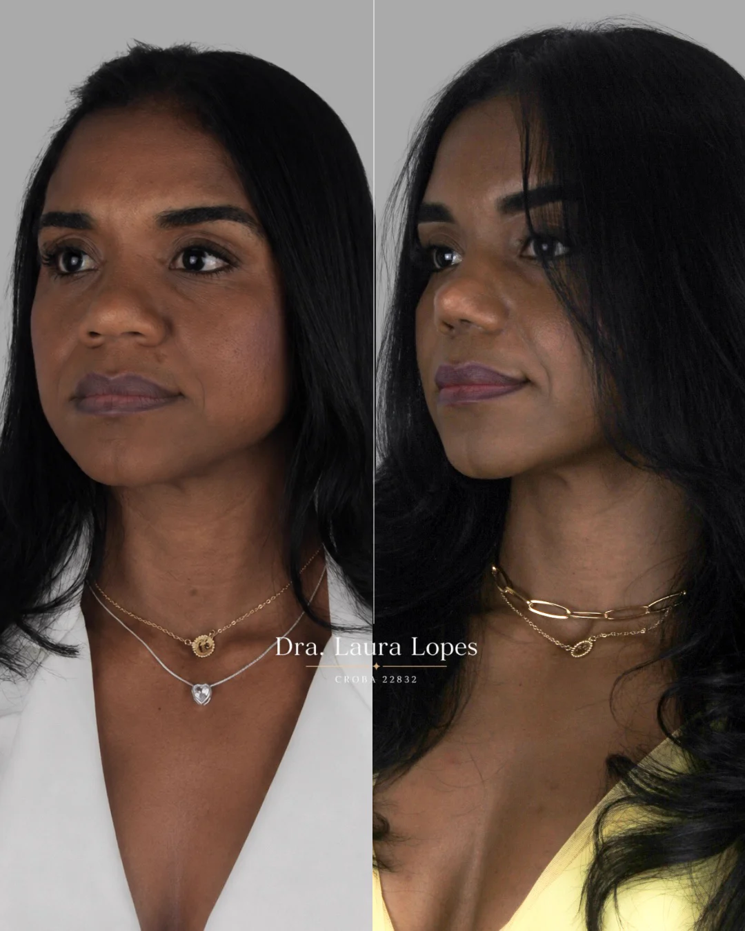 Paciente 2 — comparação antes e depois de rinomodelação avançada vista de perfil