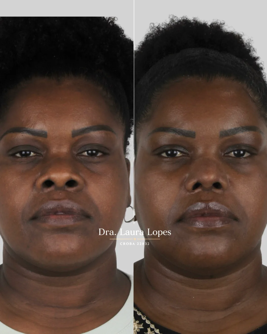 Paciente 4 — comparação antes e depois de rinomodelação avançada vista frontal