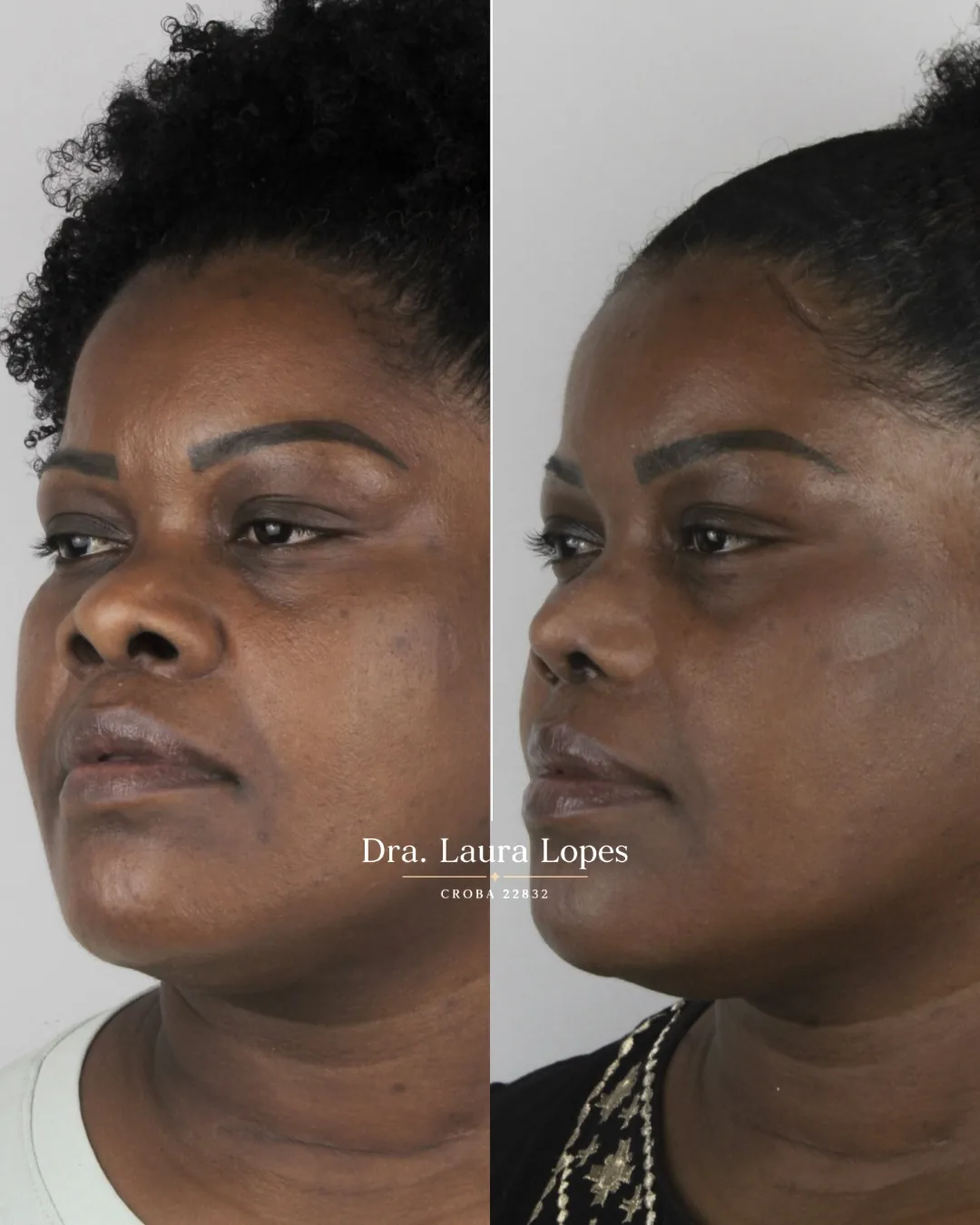 Paciente 4 — comparação antes e depois de rinomodelação avançada vista de perfil