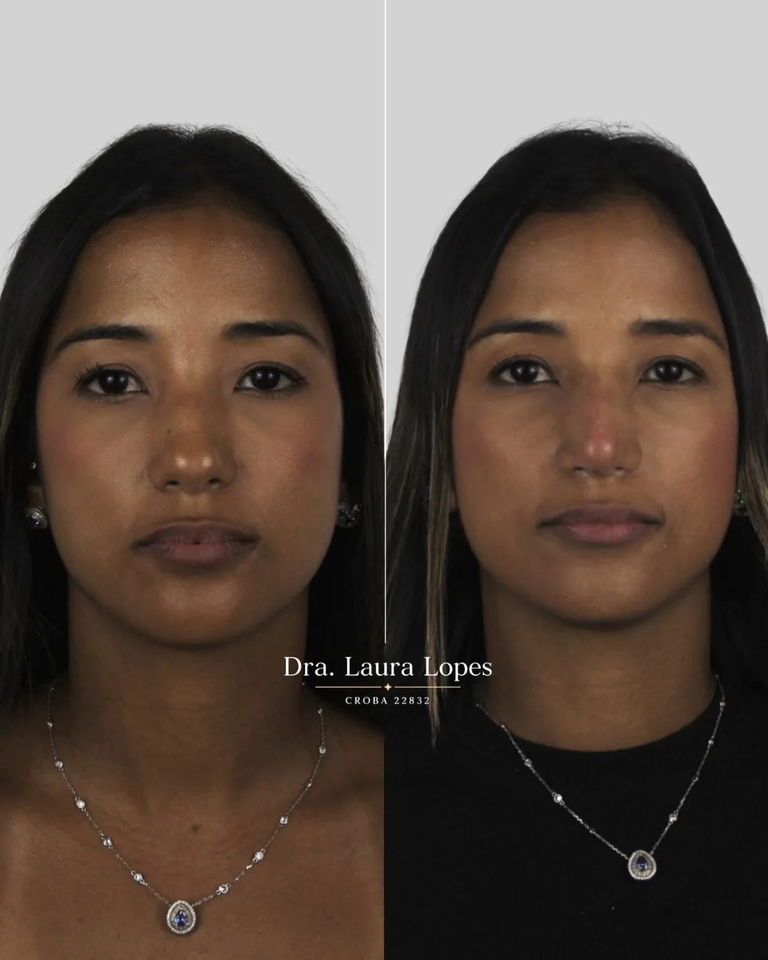 Paciente 3 — comparação antes e depois de rinomodelação avançada vista frontal