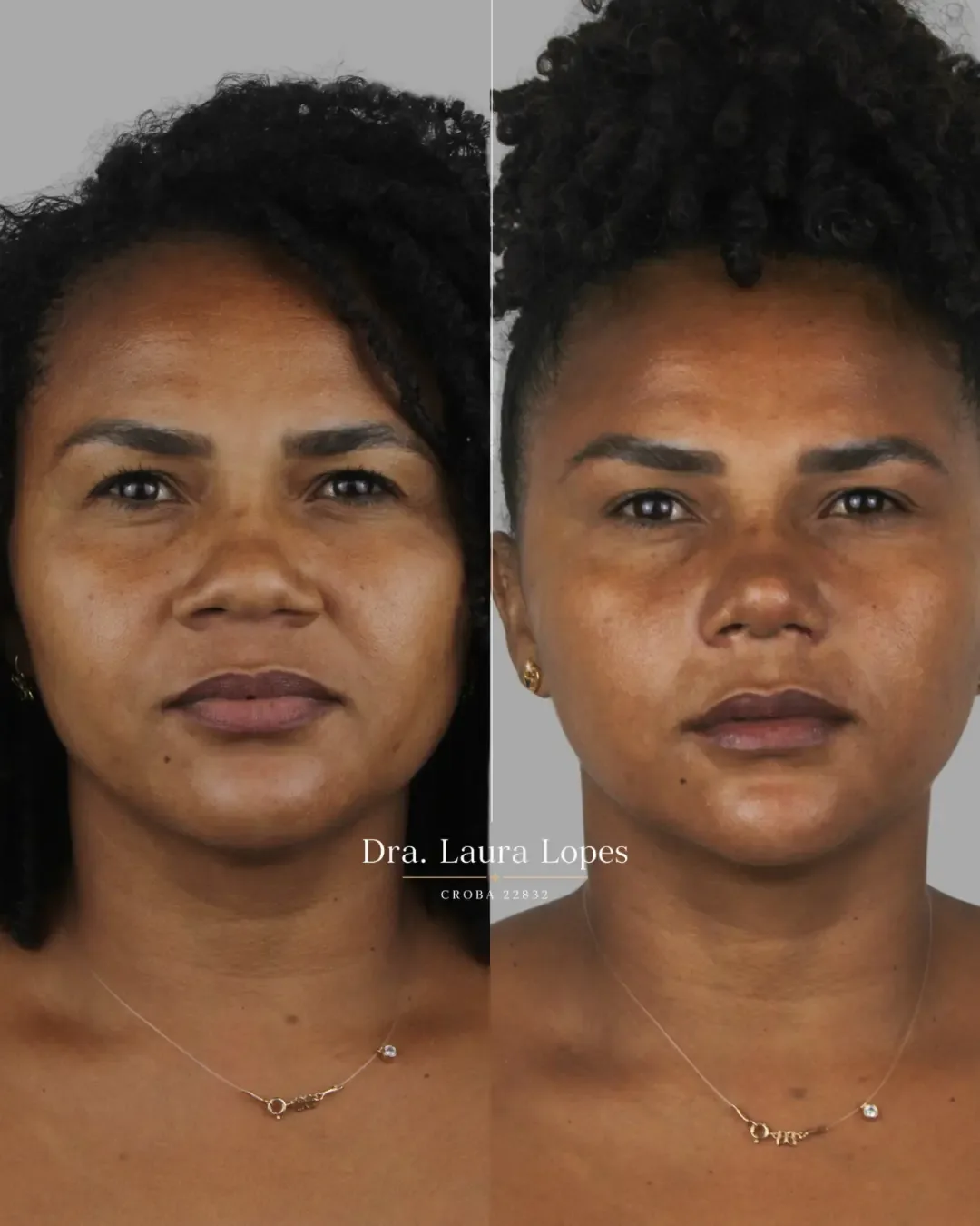 Paciente 6 — comparação antes e depois de rinomodelação avançada vista frontal