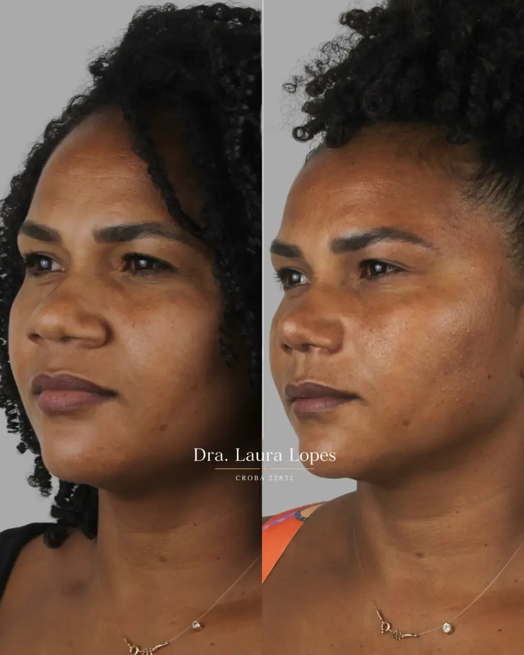 Paciente 6 — comparação antes e depois de rinomodelação avançada vista de perfil
